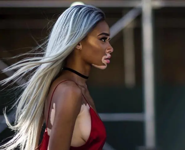 Winnie Harlow, primera modelo con vitíligo:WINNIE HARLOW