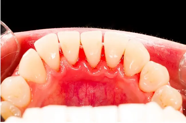 como remover el sarro dental