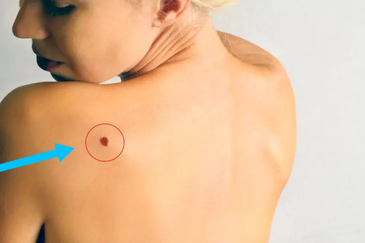 ¿Qué significan estos puntos rojos en la piel?