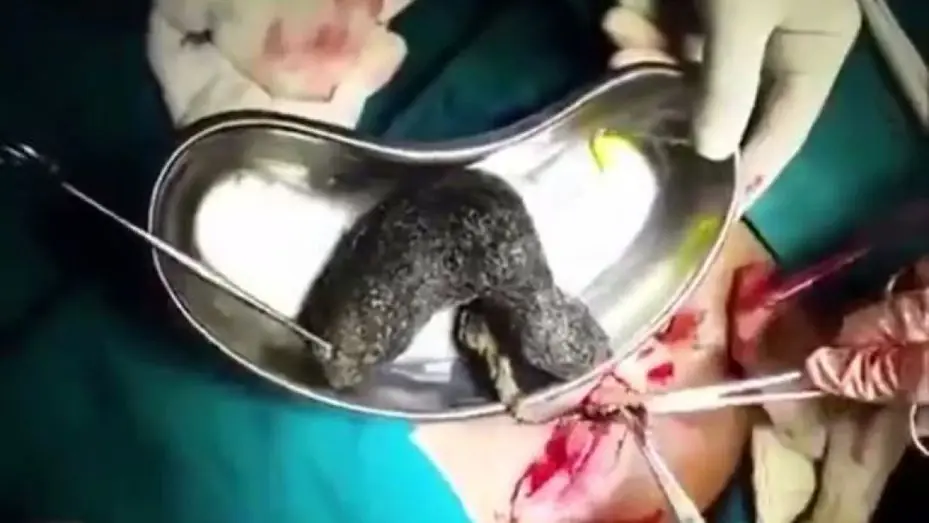 La increíble bola de pelo que le sacaron del estómago