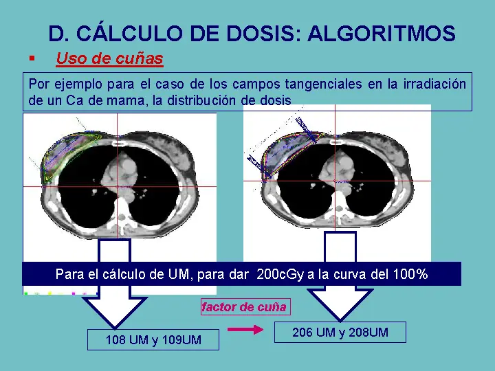 radioterapia