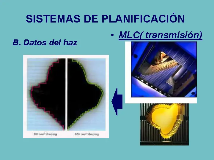 radioterapia