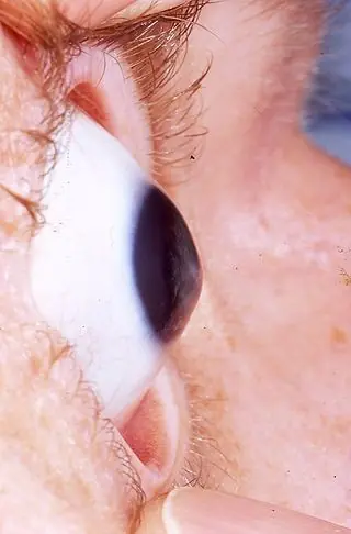 cornea