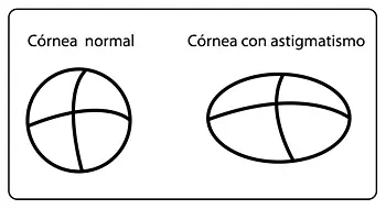 astigmatismo