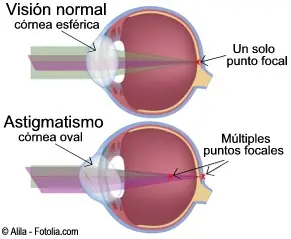 ¿Qué es el astigmatismo?