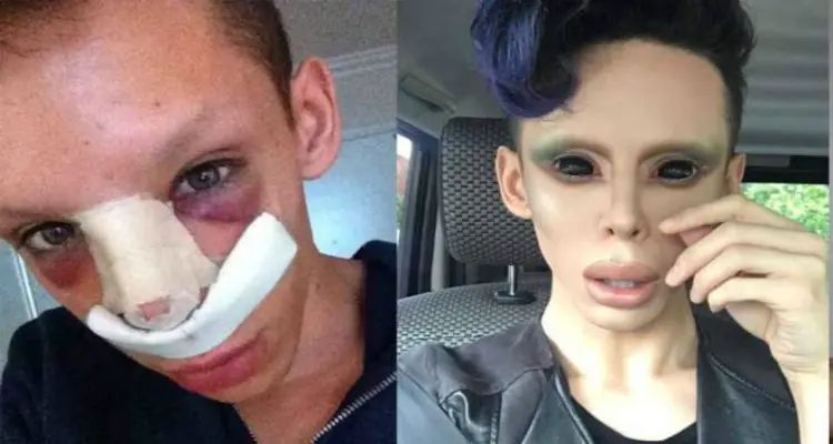 Se somete a 110 cirugías para parecer un “marciano asexual”