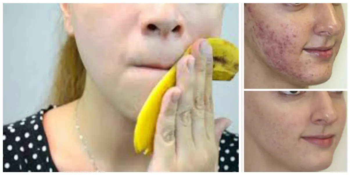 Elimina para siempre el acne, blanquea tus dientes y más