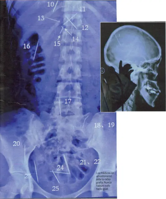 17 Radiografías Inusuales.