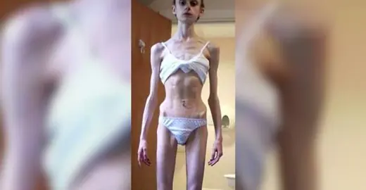anorexia
