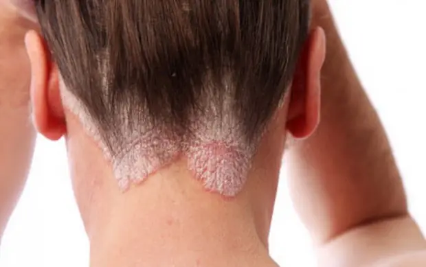 Remedios caseros para eliminar la Psoriasis