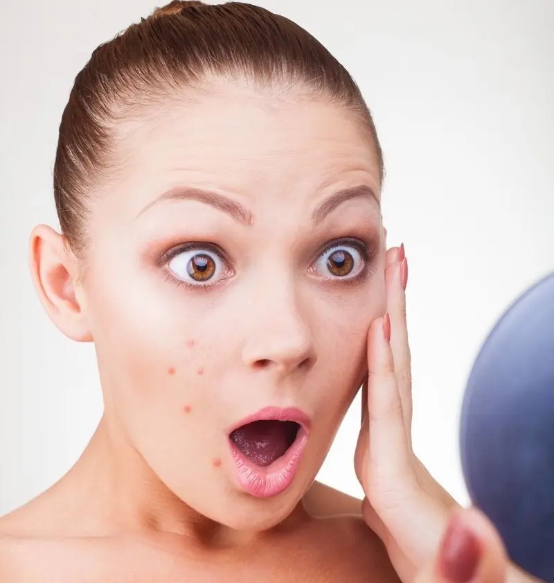 ¿Tienes acné? Este post te servirá mucho, infografias y más