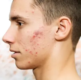 solucion al acne