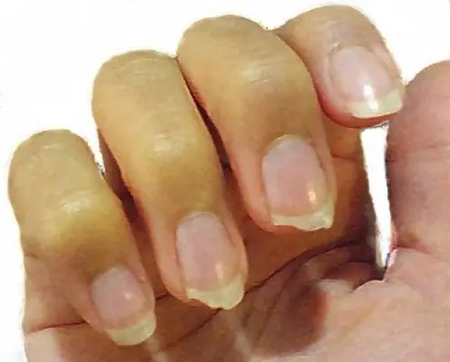 alteraciones en las uñas que podrían ser síntomas negativos