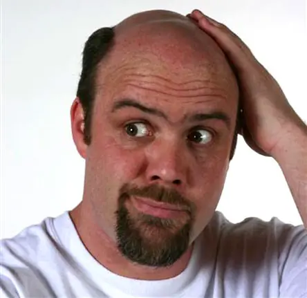 ¿por que los hombres nos quedamos pelados?.