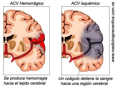 ACV Lo que tenés que Saber (Conciso)