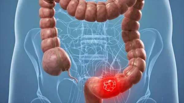 Cáncer de Colon es curable si se detecta a tiempo