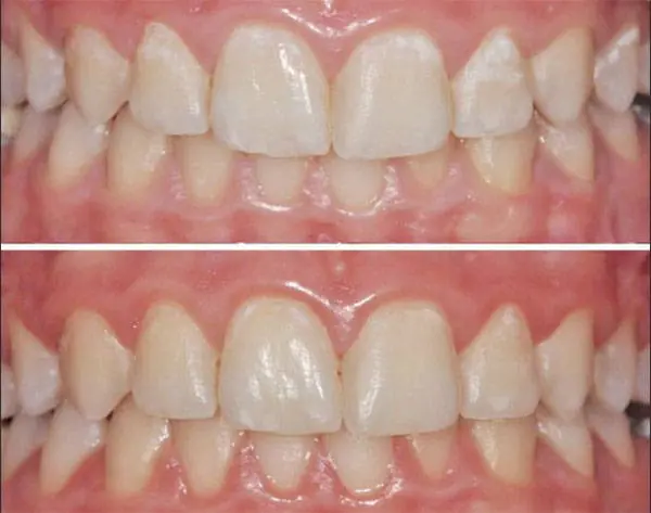 Pasta Dental Natural Remineralizante Regenera los Dientes