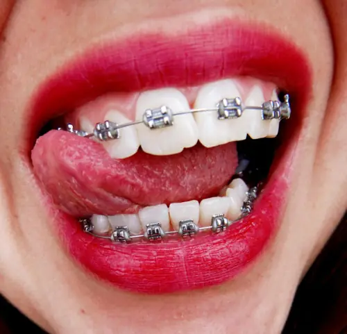 brackets