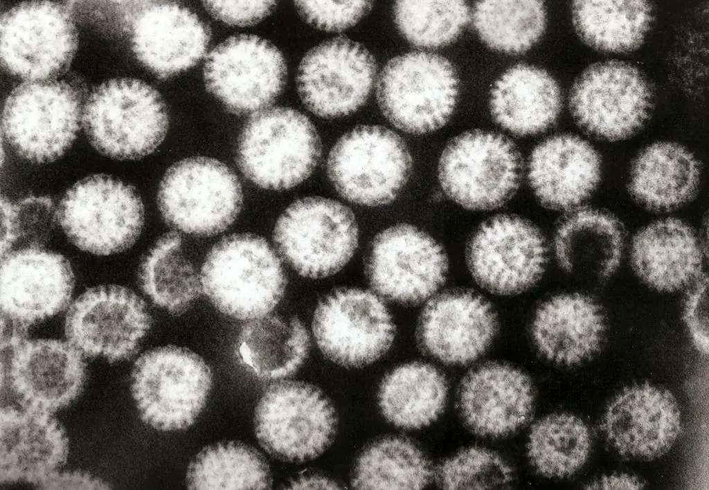 hepatitis