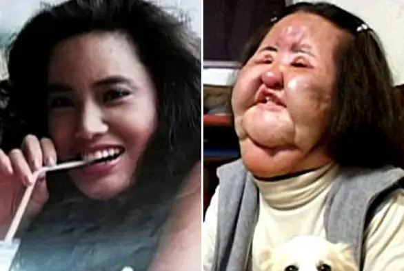 Locos por la cirugía estética