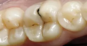 ¡Receta para curar las caries de los dientes para siempre!