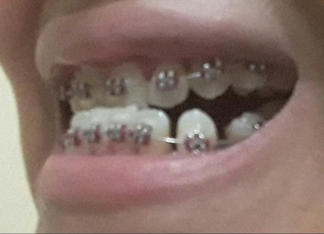 Bracket