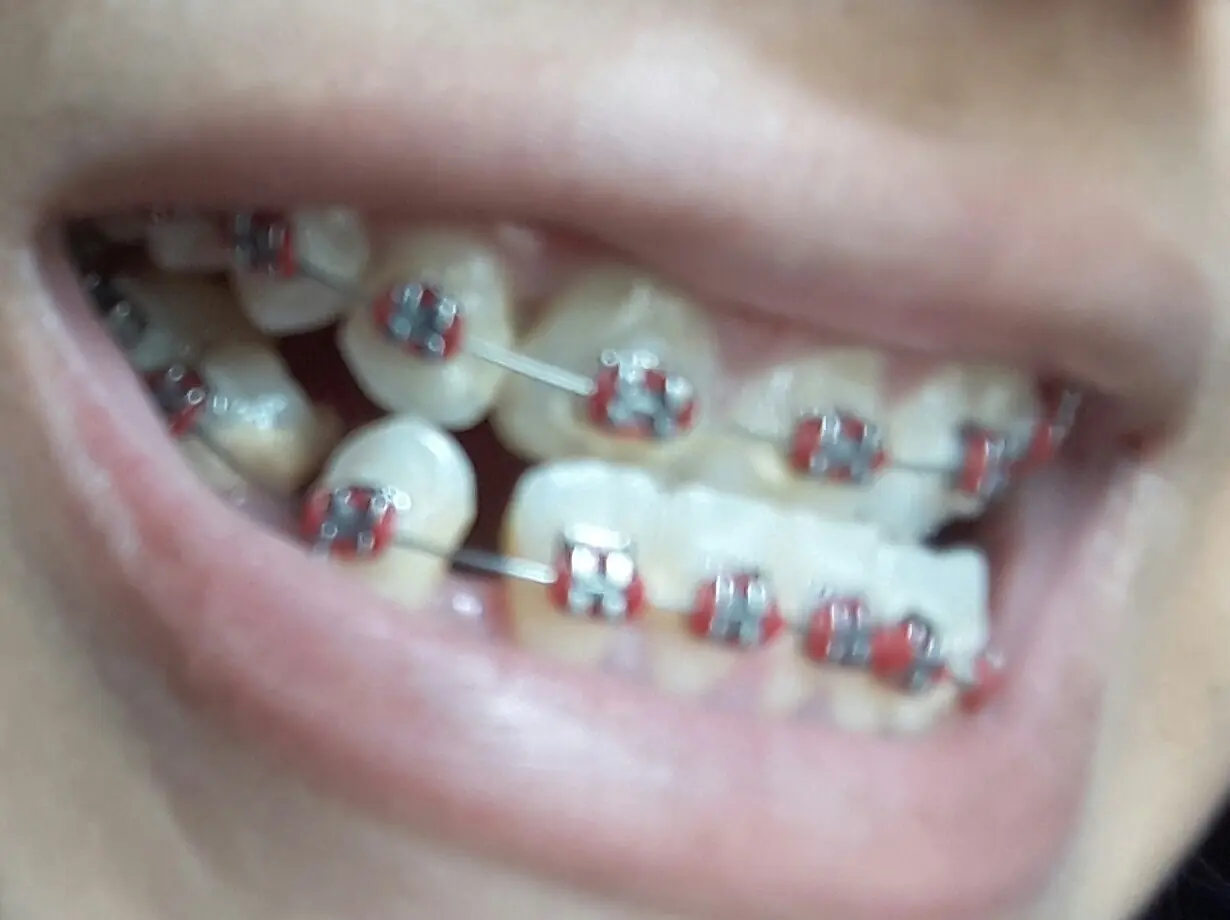 Maloclusion clase III