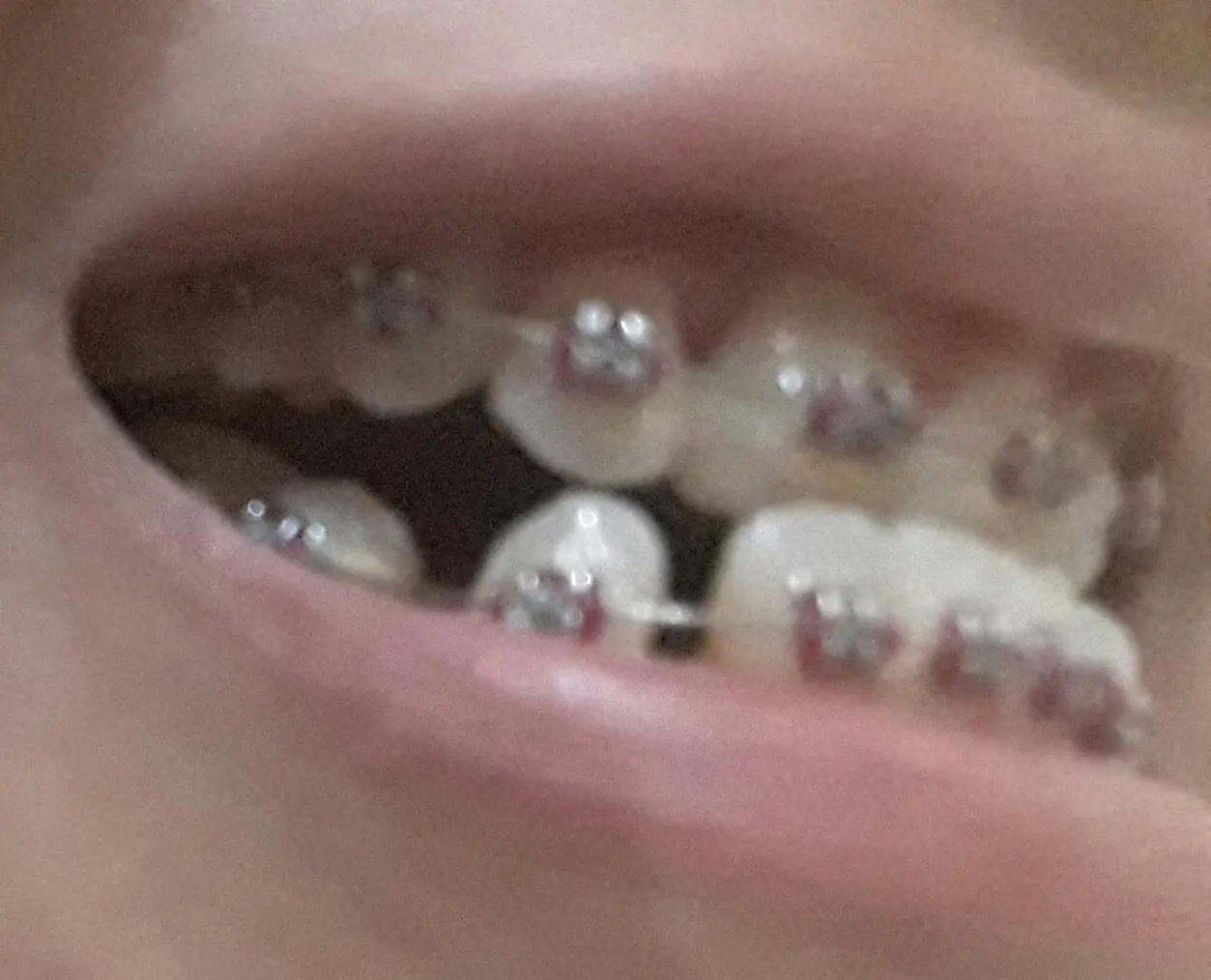 Mi experiencia con la ortodoncia (10mo post)