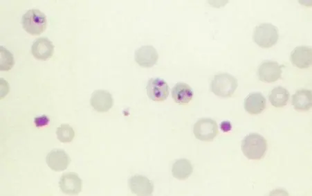 exohemoglobina