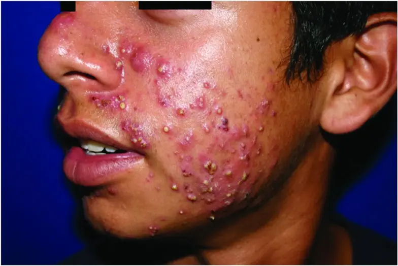 acne acne