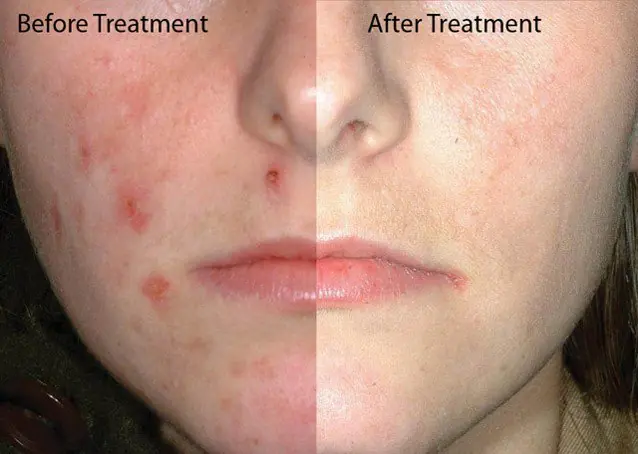 Truco para quitar las espinillas en 5 minutos(Puntos negros)