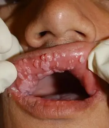 el hpv aumenta un 130% el riesgo de cancer de boca