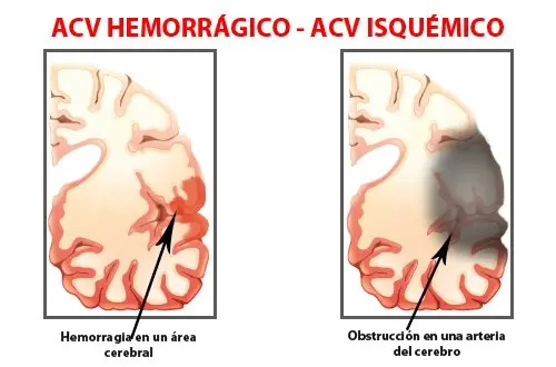 efectos sobre la salud no dormir