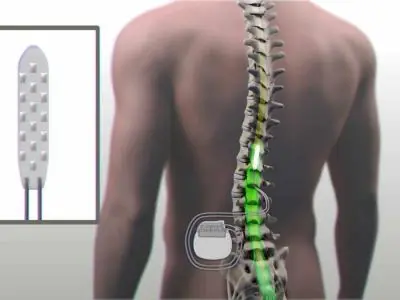 Un dispositivo implantado permite caminar a un paralítico
