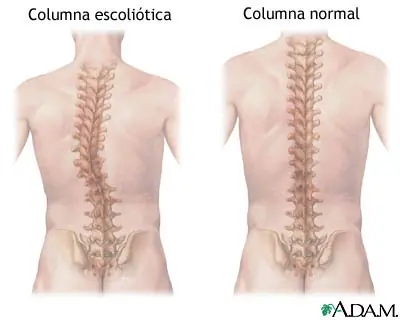 Escoliosis, todo lo que debés saber
