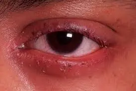 10 cosas IMPRESIONANTE que dicen tus ojos sobre tu salud