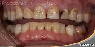 caries