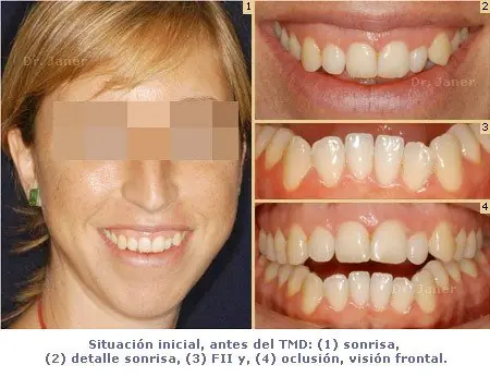 Retrognatismo Mandibular