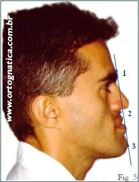 Retrognatismo Mandibular