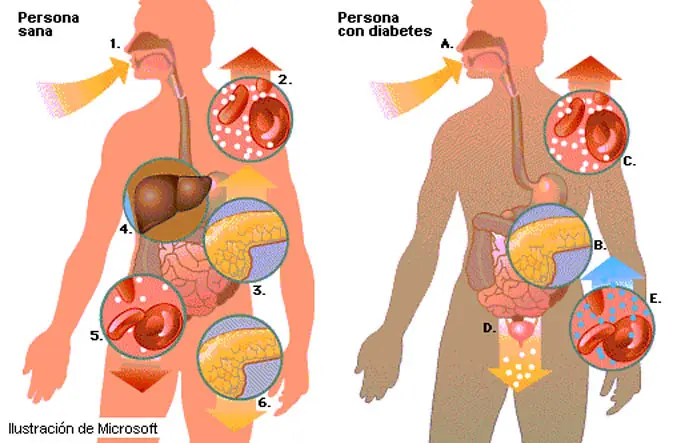 ¿Que es la diabetes?
