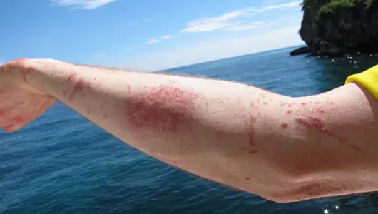 Aguas vivas en playas argentinas. ¿Qué son? ¿Qué hacer?