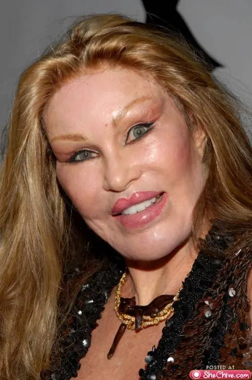 botox