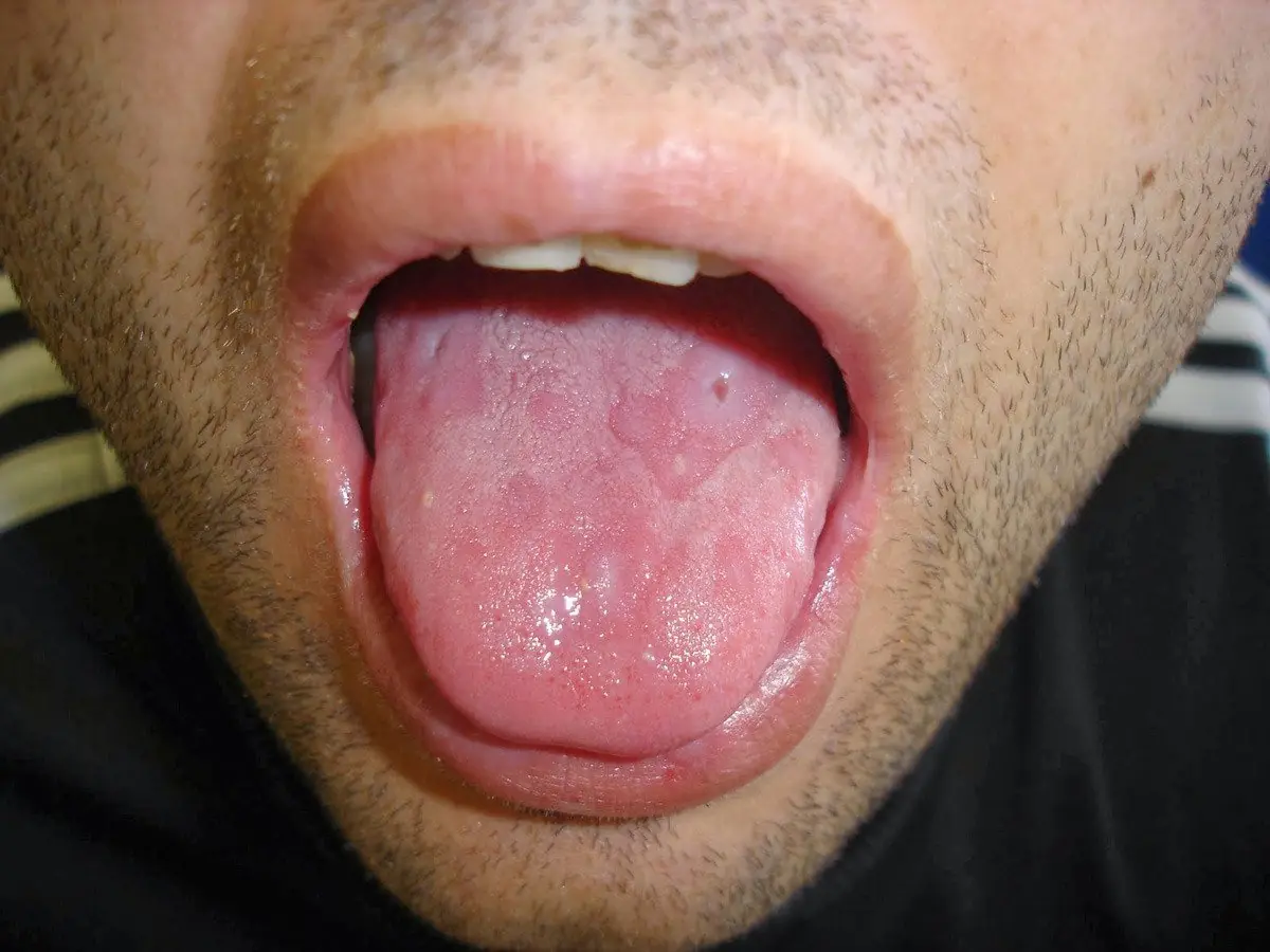 Tu lengua avisa cuando estás apunto de sufrir una enfermedad