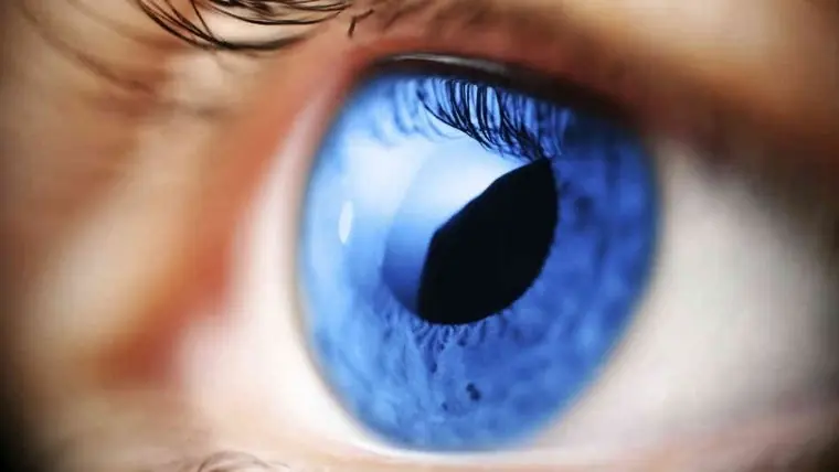 Glaucoma
