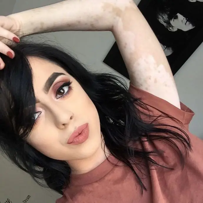 vitiligo