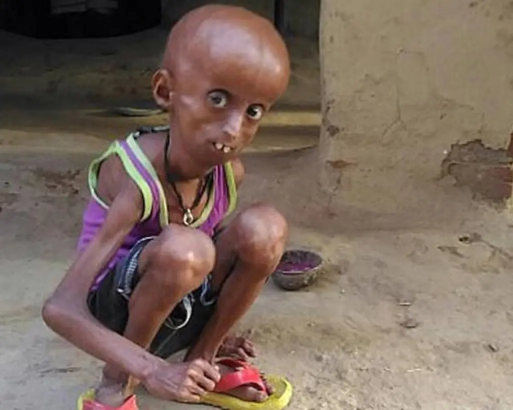 Tiene 21 años y vive atrapado en el cuerpo de un anciano