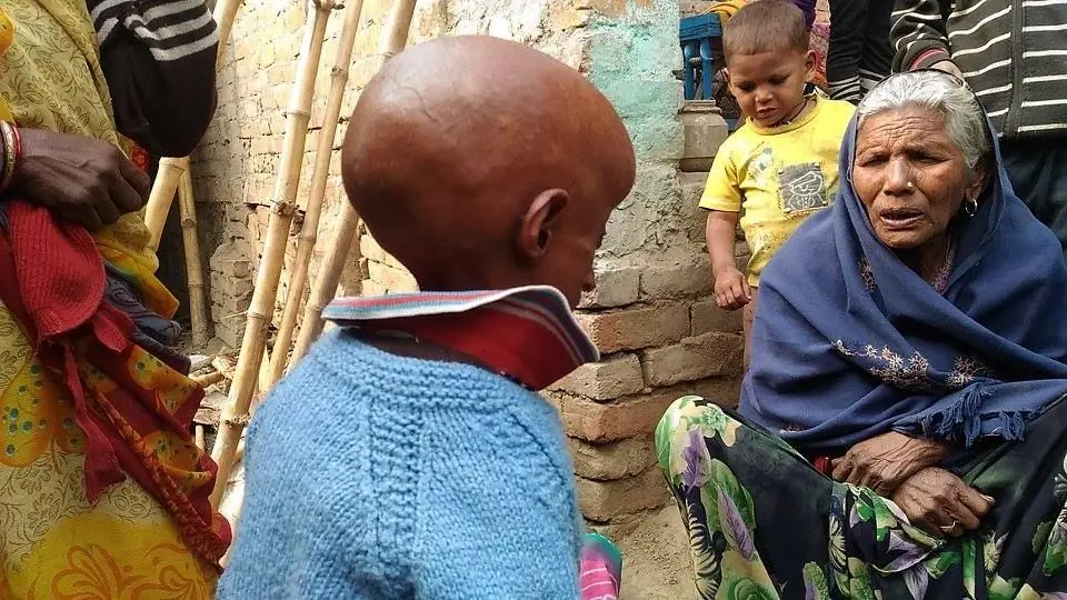 Tiene 21 anos y vive atrapado en el cuerpo de un anciano