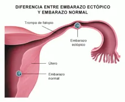 Embarazo