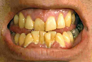 dientes