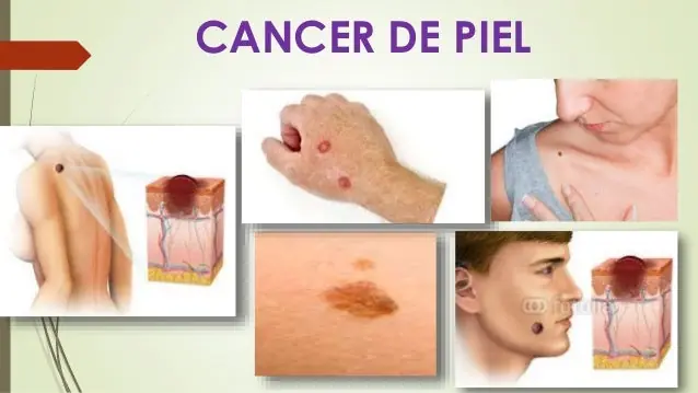 7 Primeros síntomas de cáncer que el 90% de personas ignoran